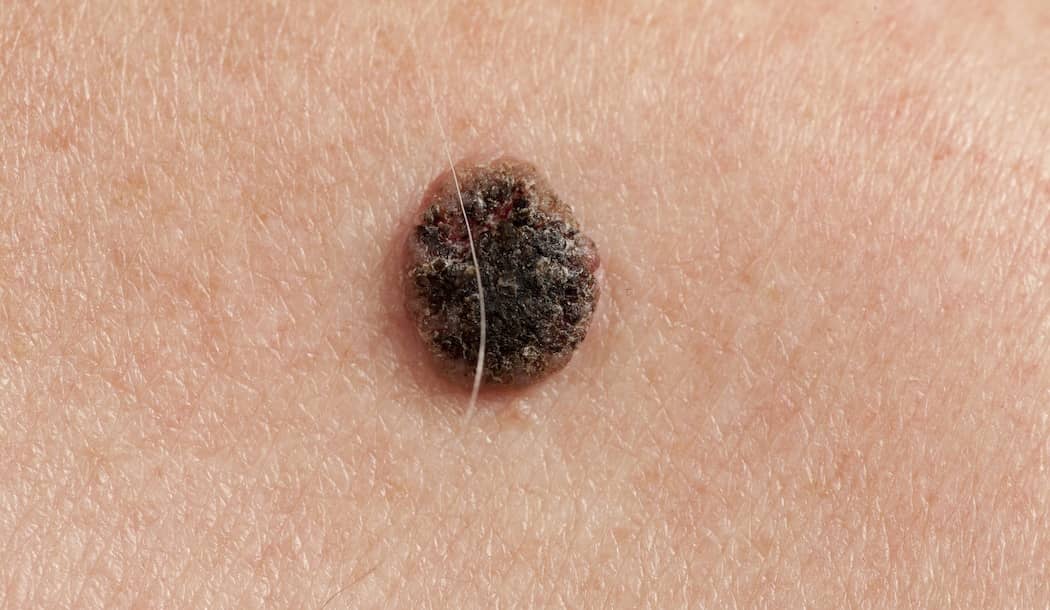 This Breast “Carcinoma” Isn’t Even Cancer – Don’t Let It Scare You about undefined
